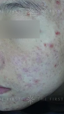 [Before]여드름 · 흉터