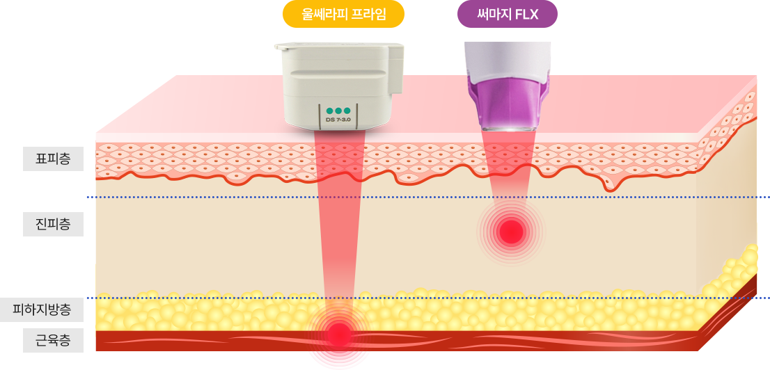 멀티레이어 리프팅